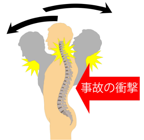 脊椎のズレや歪みは湿布や注射では治りませんし筋肉の損傷も湿布だけでは改善しません。